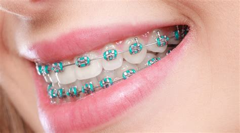 metal braces bracket colors|metal braces with color bands.